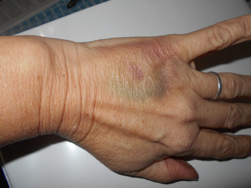 Photo of a left hand, with a large bruise on the back of the hand.